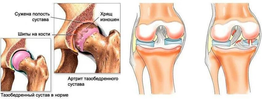 Артрит артроз тазобедренного сустава. Костный артрит тазобедренного сустава. Хрящ тазобедренного сустава. Разрыв связок тазобедренного сустава. Регенерация хряща тазобедренного сустава.