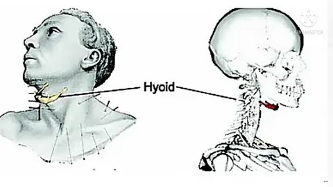 Broken neck