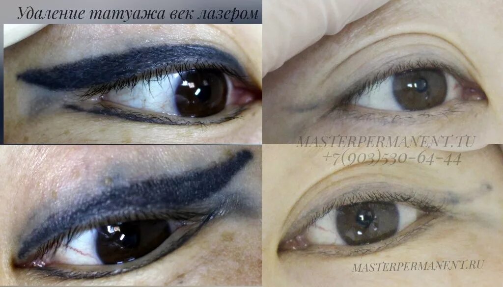 Удалить глаз татуаж. Удалить перманентный макияж век лазером. Ремувер для снятия татуажа стрелок. Татуаж век последствия. Как убрать татуаж с глаз.
