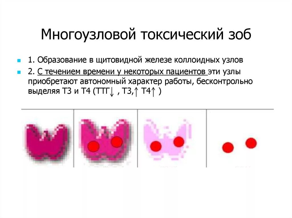 Коллоидный зоб гистология. Щитовидка Узловой зоб лекарство. Многоузловой токсический зоб клиника. Узловой нетоксический зоб классификация.