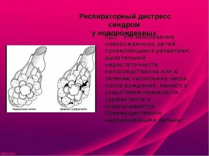 Респираторный дистресс новорожденных