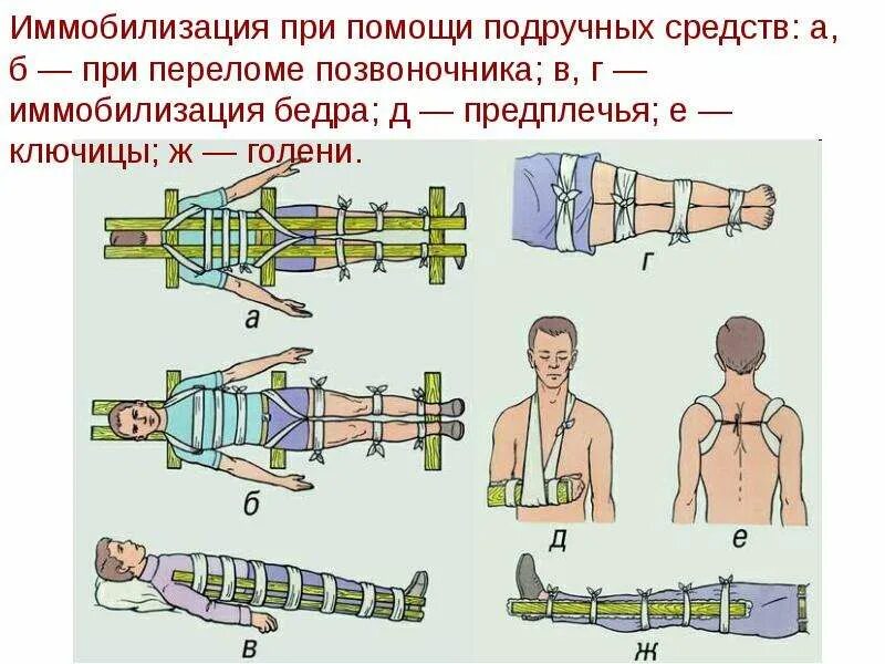 Иммобилизация переломов. При переломе позвоночника. Принципы транспортной иммобилизации при переломах костей. Иммобилизация при переломе позвоночника.