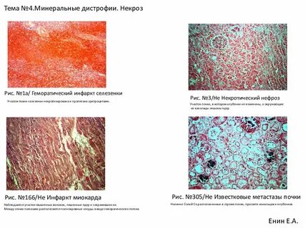 Дистрофия стромы