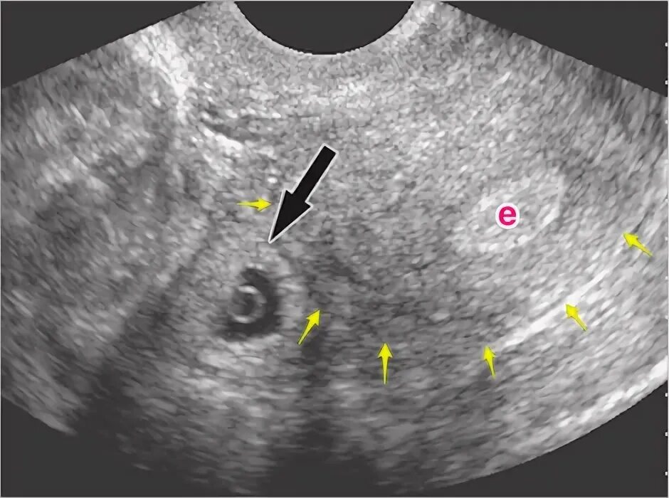 Шеечная беременность УЗИ. УЗИ интерстициальной внематочной беременности. Яичниковая внематочная беременность. На узи видно внематочную
