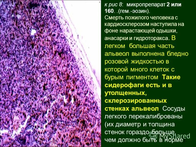 Шок вопросы. Шоковое легкое микропрепарат. Инфаркт лёгкого микропрепарат. Геморрагический инфаркт легкого микропрепарат. Легочное сердце микропрепарат.