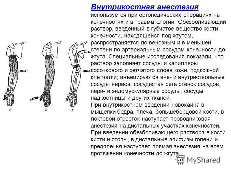 Внутрикостная блокада. Внутрикостная анестезия хирургия. Проводниковая анестезия применяется при операциях на. Проводниковая внутрикостная анестезия. Анестезия верхней конечности.