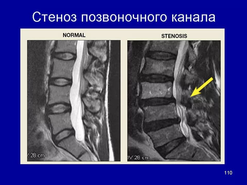 Поясничный абсолютный стеноз