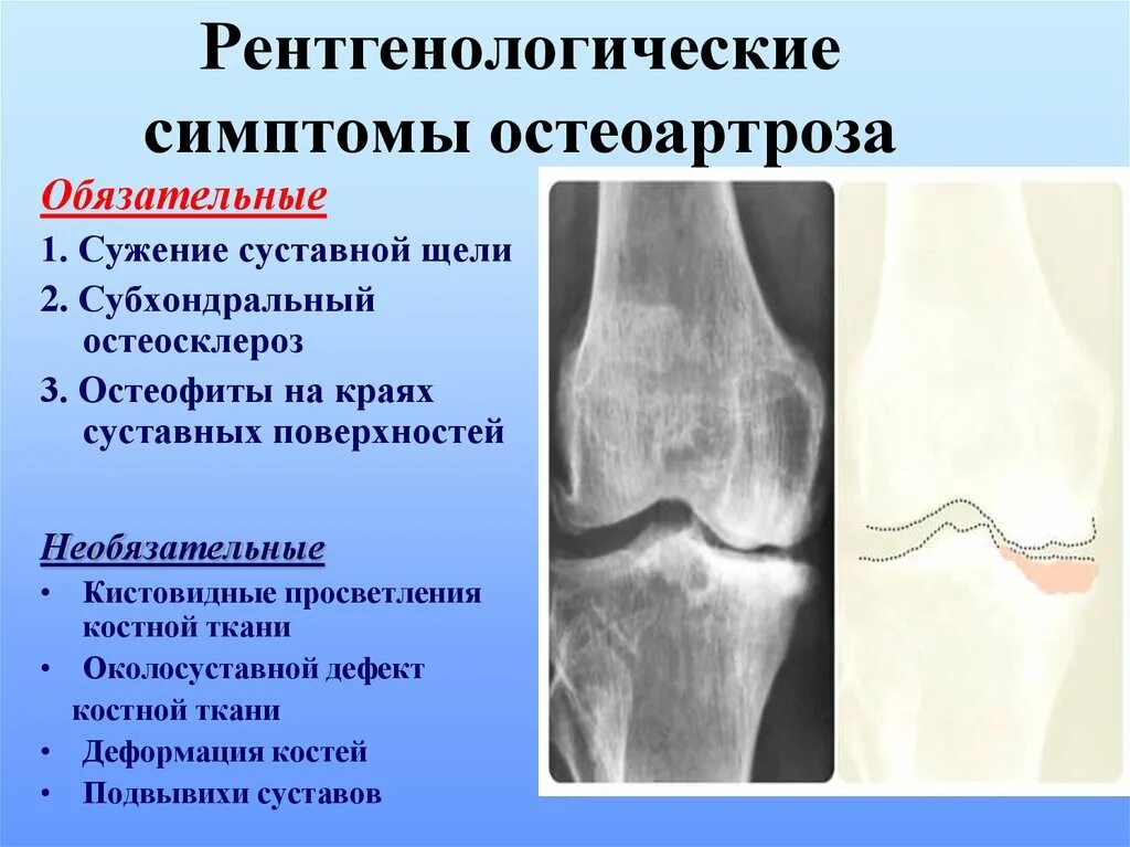 Явления остеоартроза