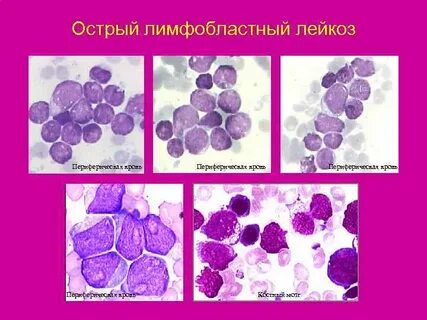 Острые лимфобластные лейкозы нмо