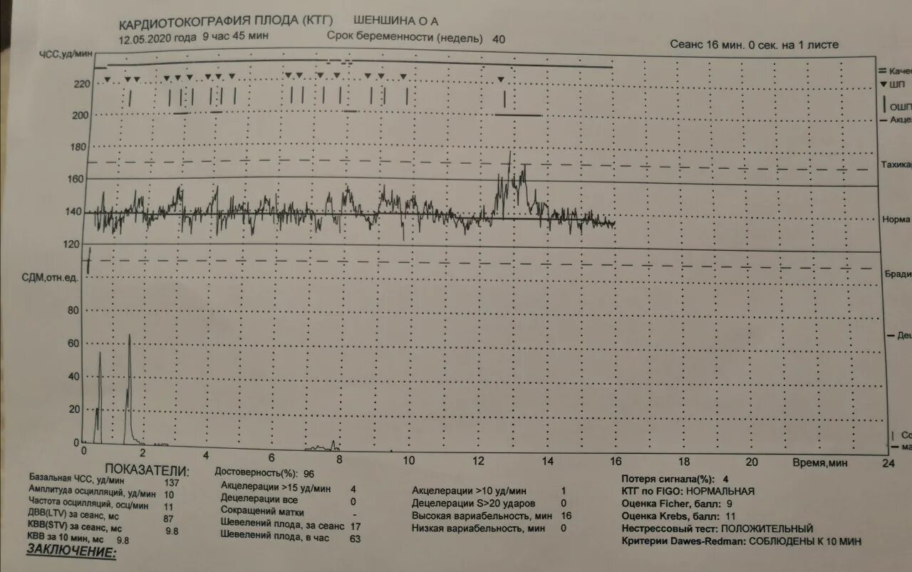 Исследование сердцебиения плода. КТГ нормальный Тип Кривой. Кардиотокография плода норма. Плохие показатели КТГ. КТГ Уникос 01.
