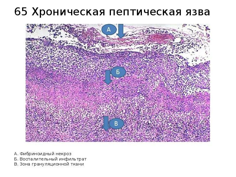 Грануляционная ткань микропрепарат. Грануляционная ткань микропрепарат патанатомия. Декубитальная язва шейки матки гистология. Хроническая пептическая язва.