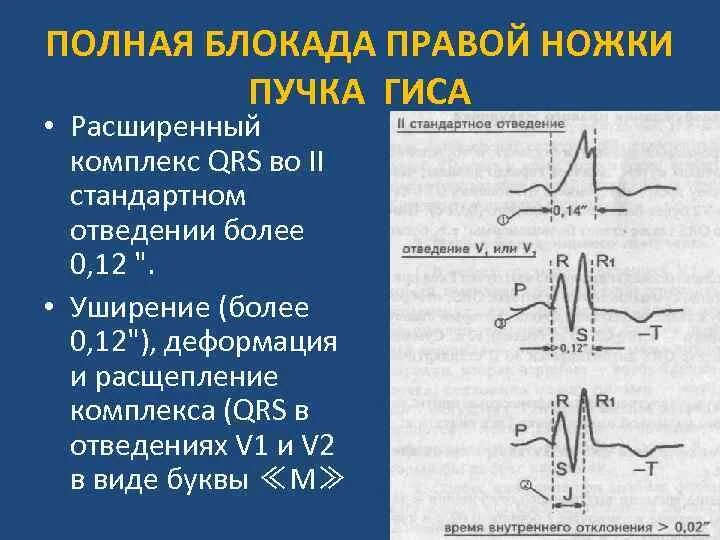 Полная блокада ПНПГ на ЭКГ. Блокада правого пучка Гиса на ЭКГ. Раздвоение комплекса QRS на ЭКГ. Полная блокада левой и правой ножки пучка Гиса. Блокада правой ножки желудочка