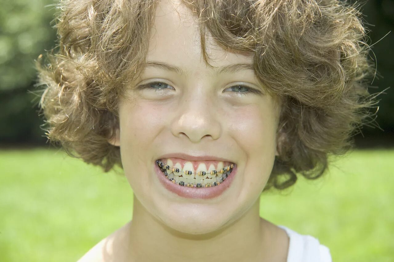 Зубы у подростков. Красивые детские брекеты.