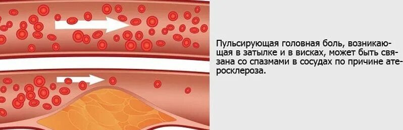 Сильно болит пульсирует. Пульсирующая боль в голове. Пульсирующая головная. Пульсирующий головной боли.