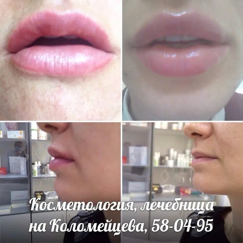 Контурная пластика губ гиалуроновой кислотой 1 мл. Лучший препарат для контурной пластики губ. Красивая форма увеличенных губ. Увеличение губ саратов фото. Увеличить губы верхняя пышма.