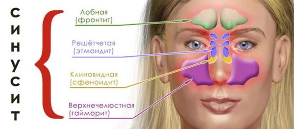 Как выглядит гайморит у детей Sinüziti Konutta Rehabilitasyon Edin Tıbbi, Sağlık ve fitness, Sağlık