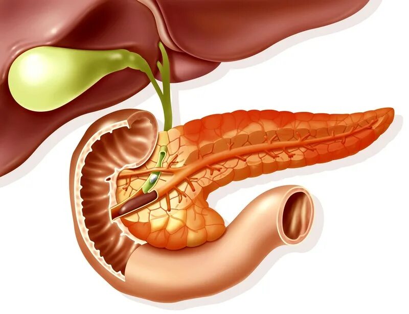 Панкреатит поджелудочной железы. Хронический панкреатит поджелудочная железа. Острый панкреатит поджелудочной железы. Острый панкреатит вирсунгов проток. Хронический билиарный панкреатит