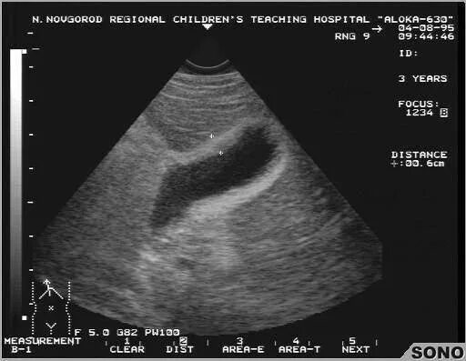 Острый деструктивный холецистит узи. Узи желчного пузыря острый холецистит. Узи при асците заключение. Кавернозная гемангиома селезенки узи. Диффузные изменения стенок желчного.