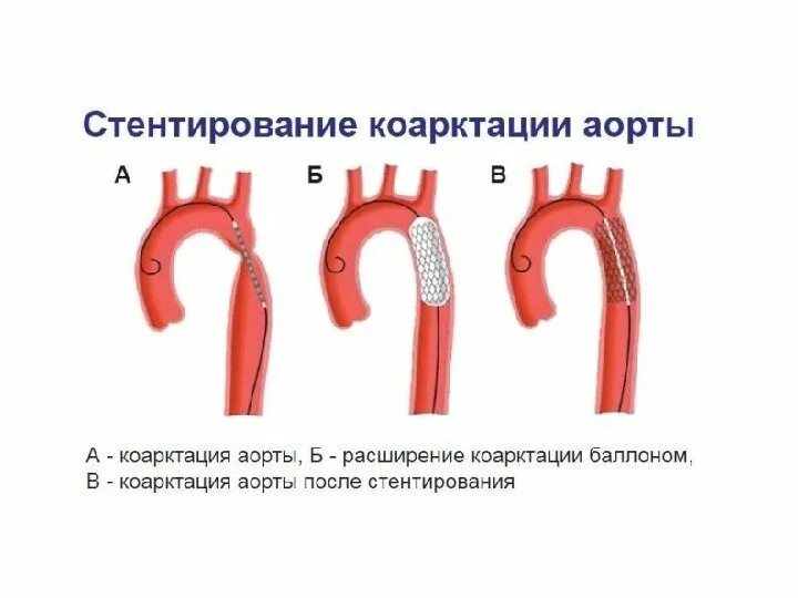 Мкб впс аортальный