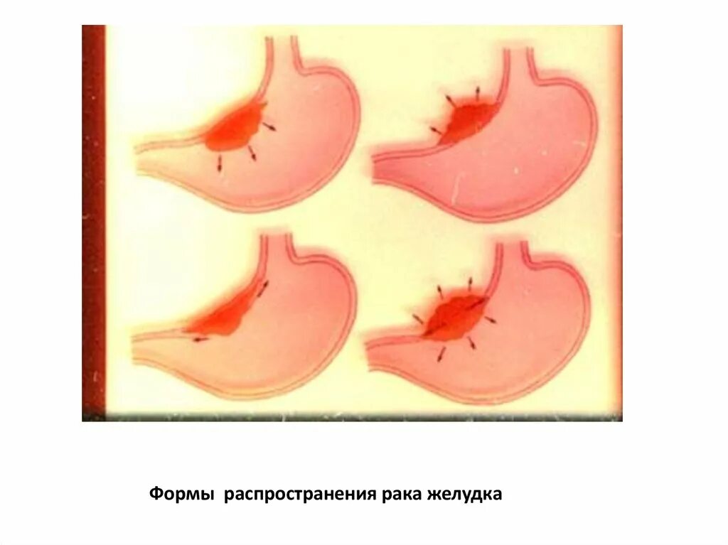 Пенетрация язвенной болезни желудка. Пенетрация осложнение ЯБЖ. Осложнения пенетрирующей язвы желудка. Осложнения язвы желудка Пенетрация. Размеры язвы желудка