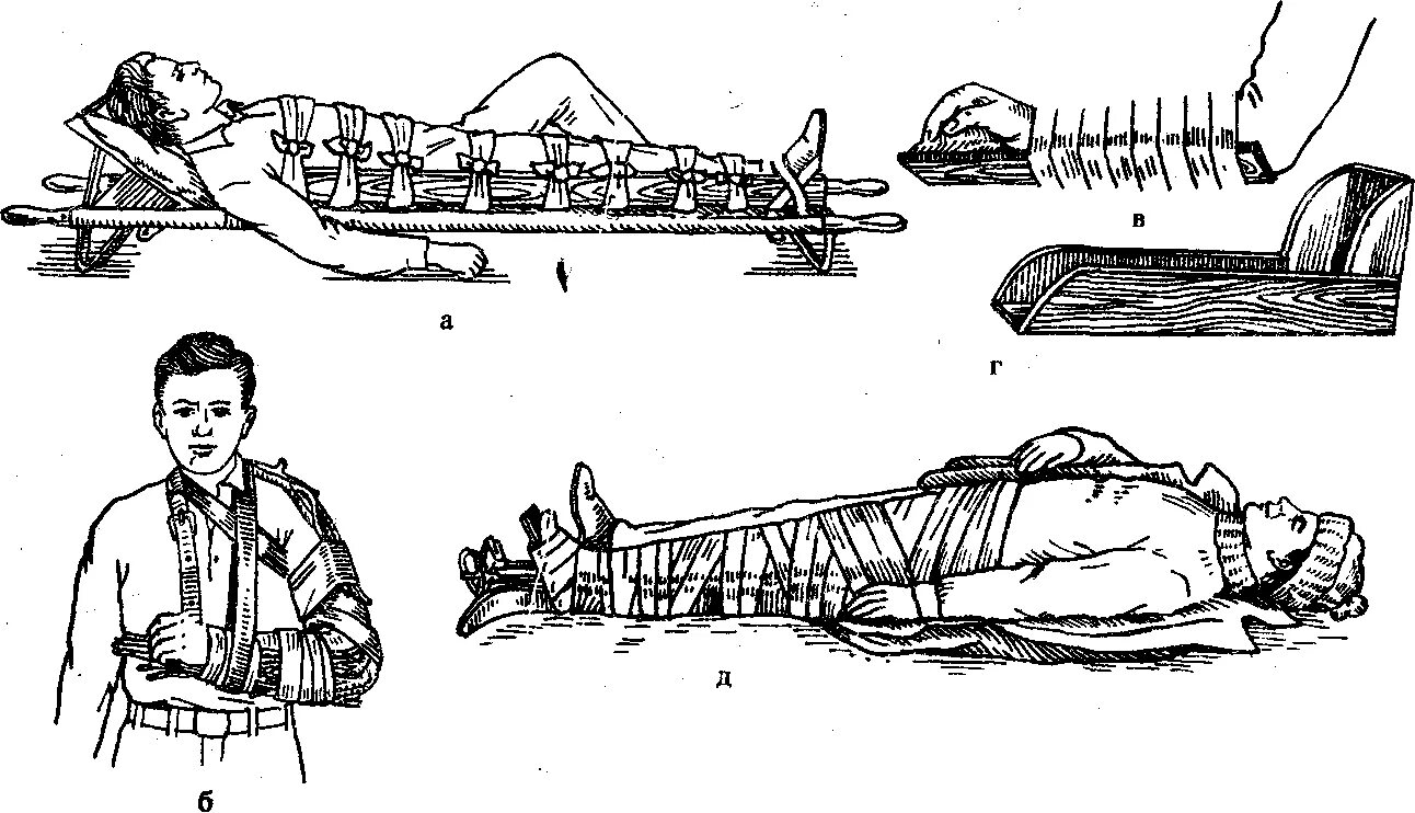 Перелом голени транспортировка. Шина Крамера перелом костей голени. Иммобилизация голени Крамера. Транспортная иммобилизация верхней конечности шиной Крамера. Транспортная иммобилизация при переломах.