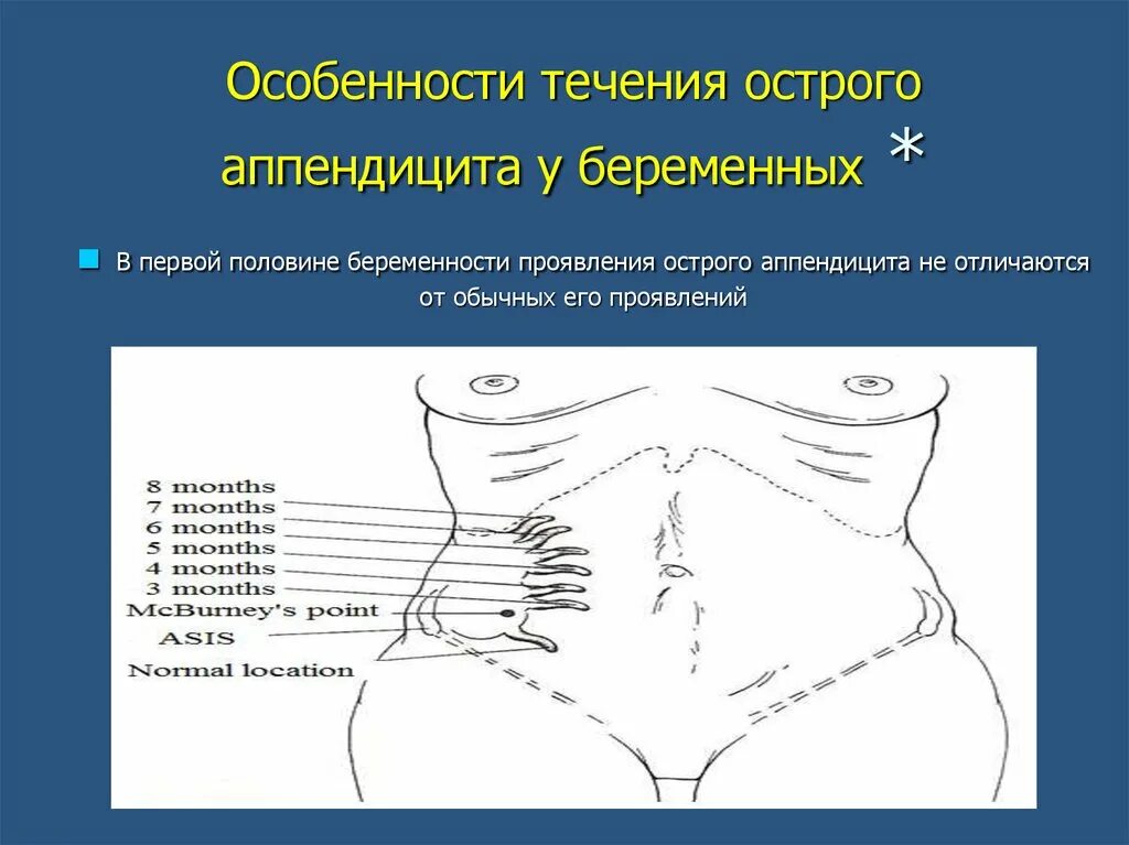 Течение острого аппендицита. Особенности течения острого аппендицита. Особенности течения аппендицита у беременных. Особенности течения острого аппендицита у беременных. Особенности острого аппендицита у беременных.