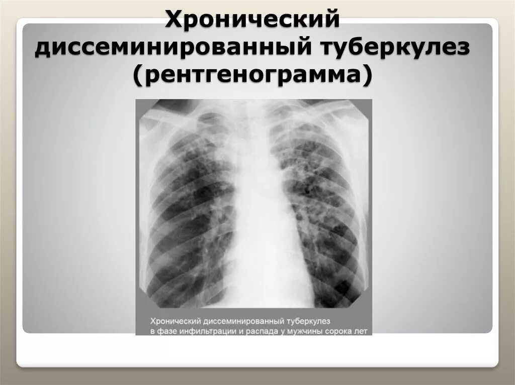 Подострый диссеминированный туберкулез рентген. Милиарный диссеминированный туберкулез. Милиарный диссеминированный туберкулез рентген. Гематогенно диссеминированный туберкулез рентген.