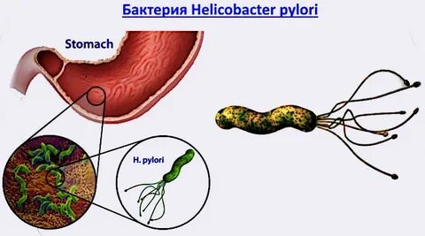 Хеликобактерный гастрит