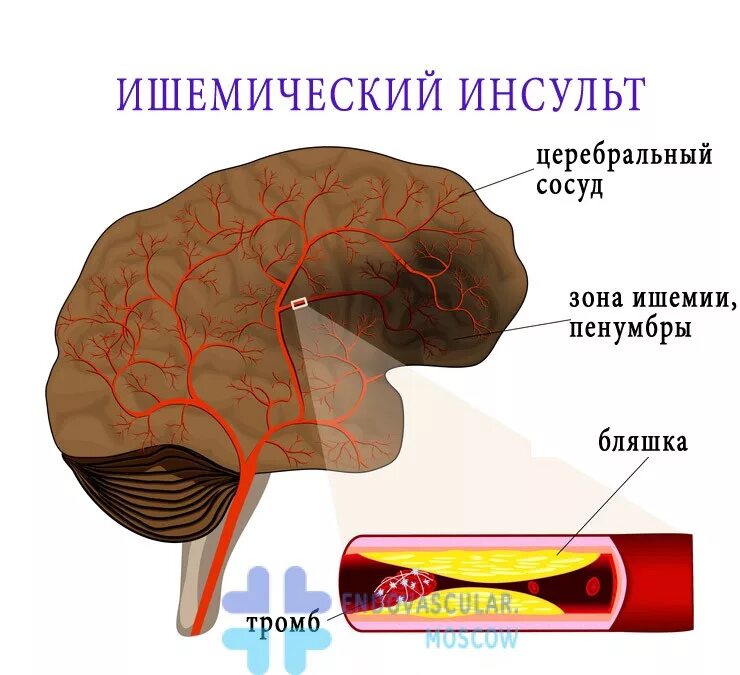 Ишемический церебральный инсульт. Инсульт ишемический (закупорка сосуда). Очаг ишемического инсульта.