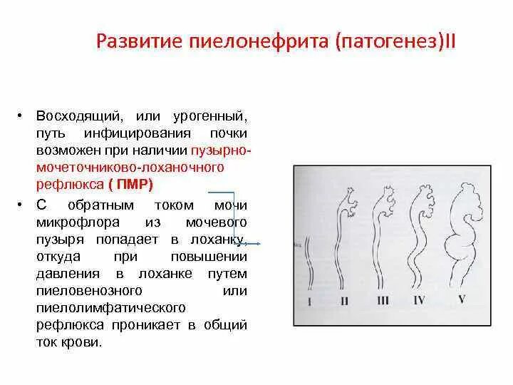 Восходящий урогенный путь. Восходящий путь инфицирования при пиелонефрите. Урогенный путь инфицирования при пиелонефрите. Урогенный восходящий пиелонефрит.