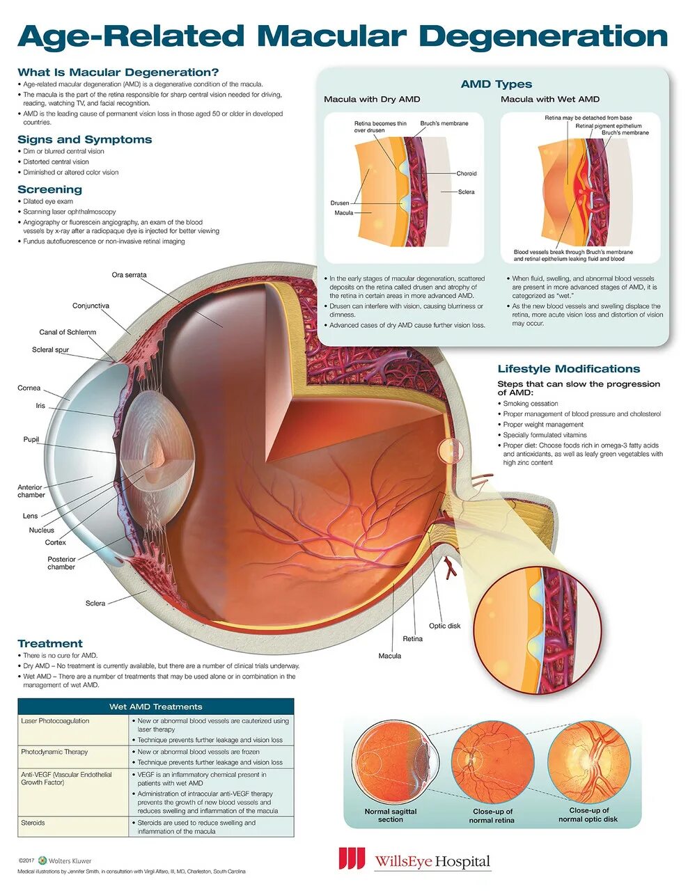 Age related Macular Degeneration Dry form.