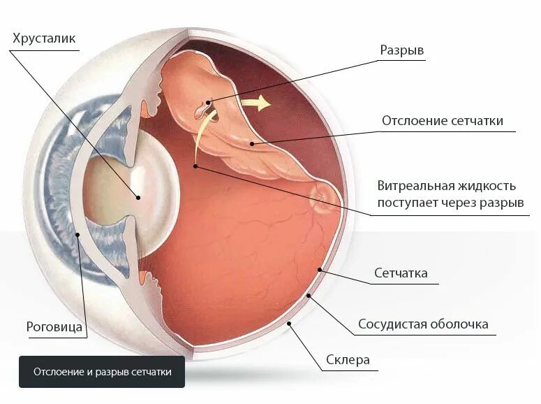Отслойка сетчатки глаза операция. Ретинальный разрыв сетчатки. О сложение сетчатки глаза. Пузыревидная отслойка сетчатки.