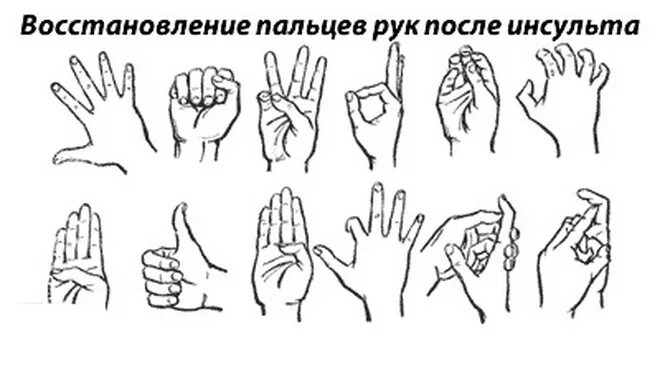 Упражнения после инсульта для рук и ног. Гимнастика для кистей рук и пальцев после инсульта. Реабилитация после инсульта упражнения для руки. Гимнастика правой руки после инсульта. ЛФК для мелкой моторики рук после инсульта.