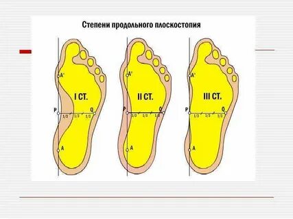 Продольное плоскостопие симптомы