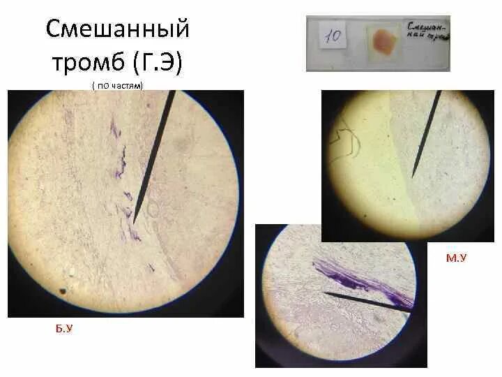 Смешанный тромб. Смешанный тромб микропрепарат. Смешанный тромб в сосуде препарат. Смешанный тромб в Вене микропрепарат.