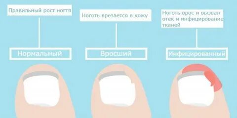 Ноготь растет в кожу
