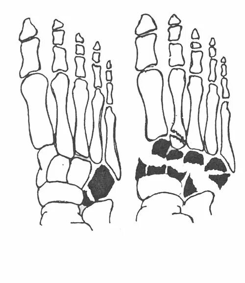 Перелом костей предплюсны стопы. Перелом плюсневой кости стопы рентген. Перелом ладьевидной кости стопы. Переломы кубовидной и клиновидных костей.