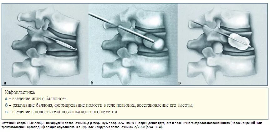 Компрессионный перелом вертебропластика. Компрессионный перелом позвоночника операция. Цементирование позвоночника при компрессионном переломе. Вертебропластика позвонка.