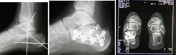 Перелом пяточной кости код по мкб 10. Угол беллера пяточной кости в норме. Рентген здоровой пяточной кости. Внутрисуставной перелом на кт. Перелом пяточной кости код по мкб 10.