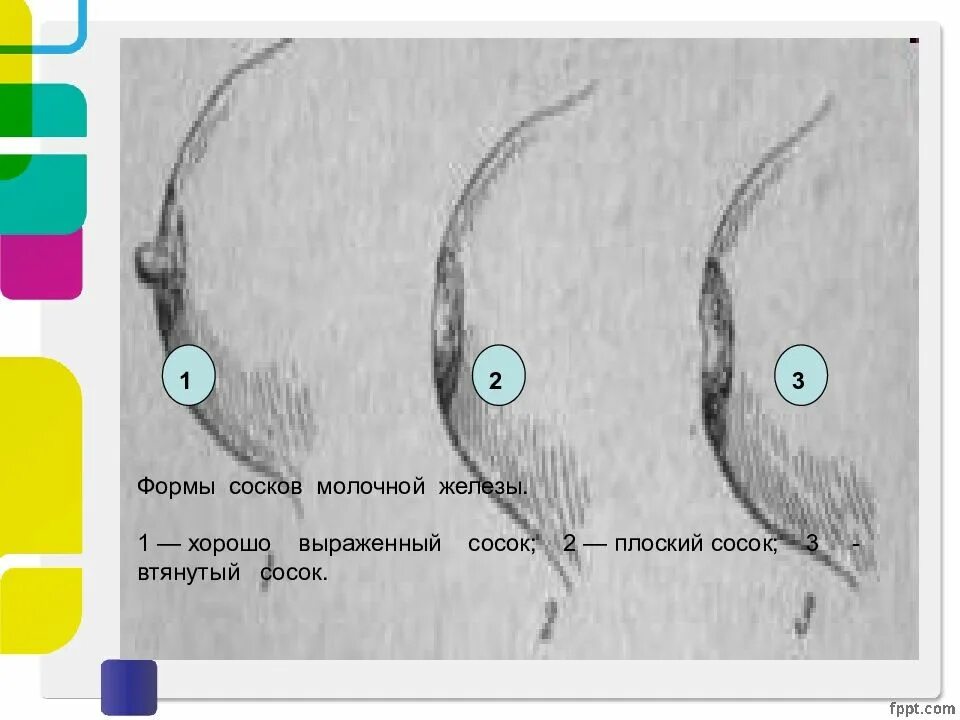 Плоская форма сосков. Плоский и втянутый сосок. Формы соска молочной железы. Втянутый сосок при онкологии молочной железы. Виды сосков у девушки