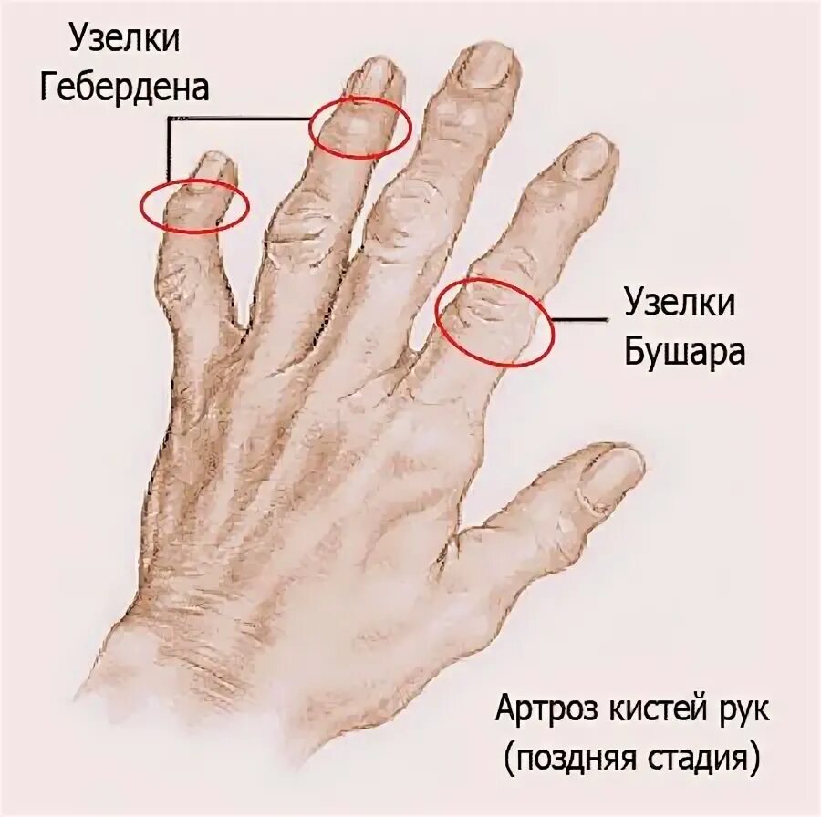 Почему появляются узлы. Узелков Гебердена и Бушара. Геберденовские узелки и узелки Бушара. Узелки Гебердена Бушара остеоартроз.