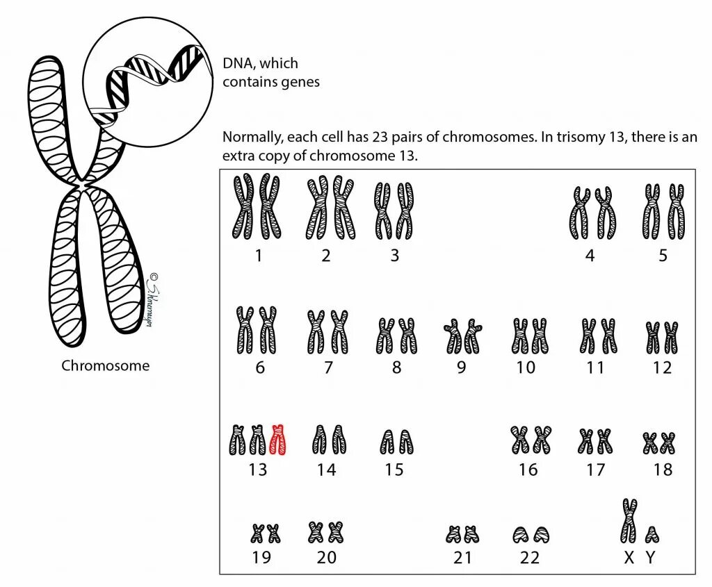 Отсутствие х хромосомы у мужчин. Синдром Патау трисомия хромосомы 13. Синдром Патау хромосомная карта. Транслокационная форма синдрома Патау кариотип. Кариотип человека при синдроме Патау.