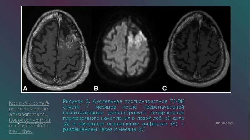 Ишемический инсульт в левой лобной доле. Ишемический инсульт лобной доли головного мозга.