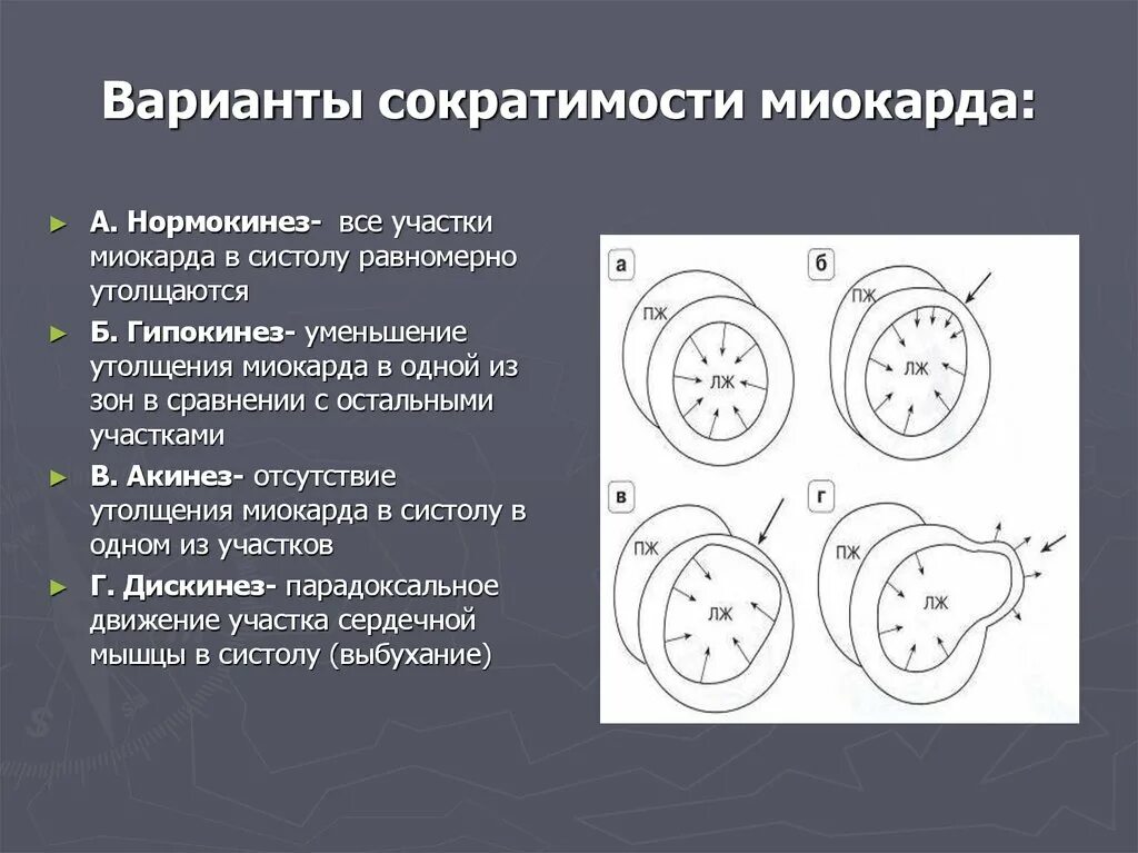 Сократимость лж. Гипокинезия миокарда. Гипокинезия миокарда ЭХОКГ. Сократимость миокарда нормокинез. Гипокинез акинез миокарда.