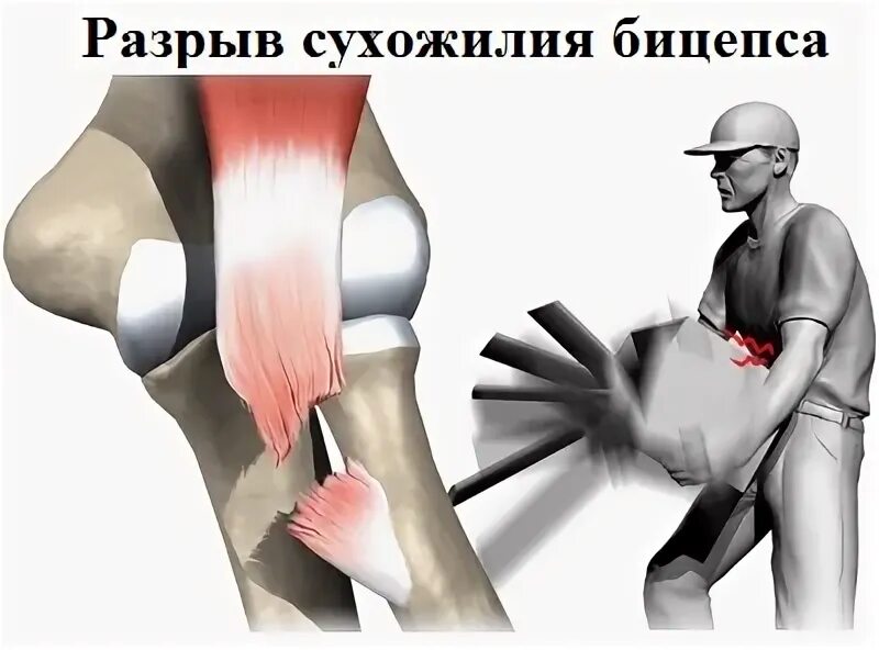 Как выглядит порванное сухожилие на руке Повреждения сухожилий разгибателей Врач Травматолог Ортопед