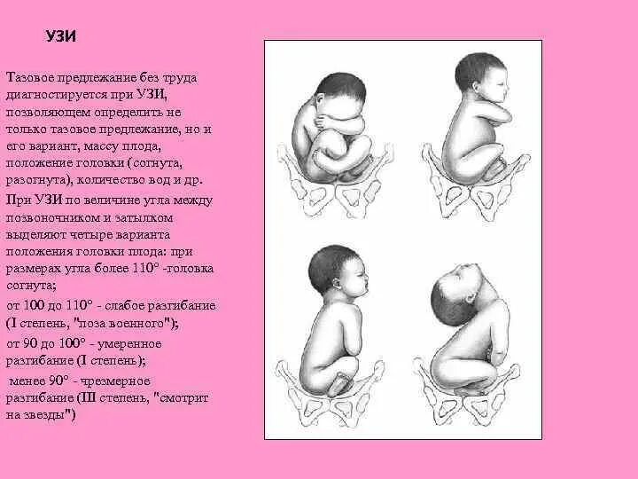 Тазовое предлежание плода на 20. Тазовое предлежание плода на 27 неделе. Положения малыша в животе тазовое предлежание. Расположение ребенка в тазовом предлежании. Тазовое предлежание на УЗИ.