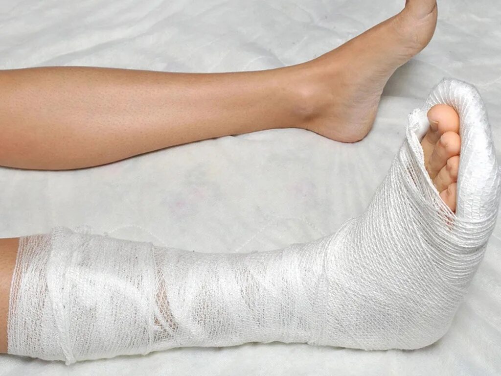 гипс при переломе коленного сустава. болит ли нога в гипсе. гипс при переломе 5 плюсневой кости. перелом пяточной кости гипсовая повязка. перелом ладьевидной кости стопы гипс.