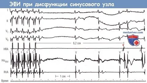 Вегетативная дисфункция синусового узла