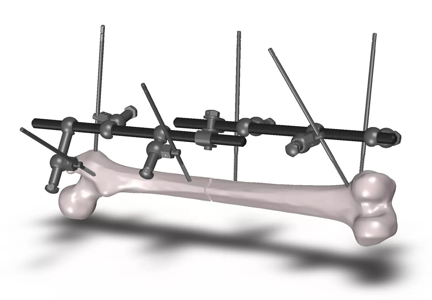 External class. External fixation systems i. declinatio iii medical.