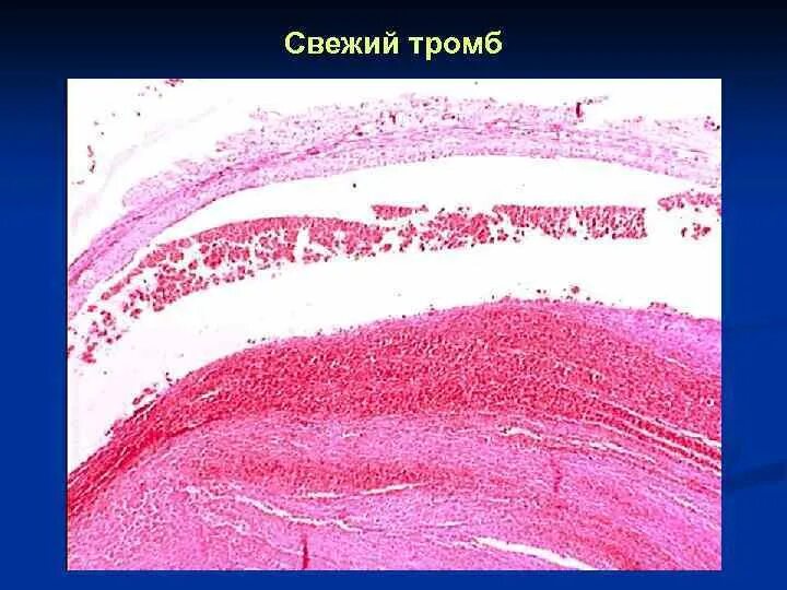 Обтурирующий тромб гистология. Красный обтурирующий тромб микропрепарат. Свежий тромб микропрепарат. Свежий тромб артерии микропрепарат. Организация тромба